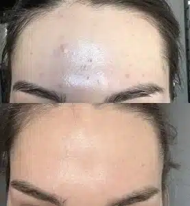 лечение акне