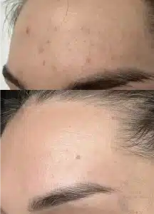 лечение акне