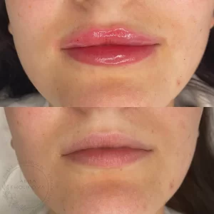 контурная пластика губ