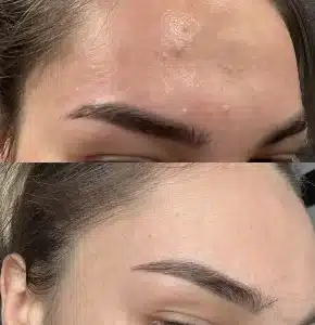 лечение акне