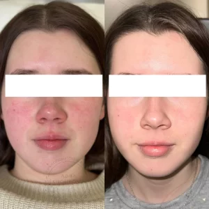 атопический дерматит