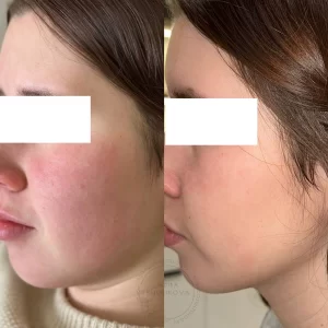 атопический дерматит