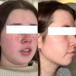 атопический дерматит