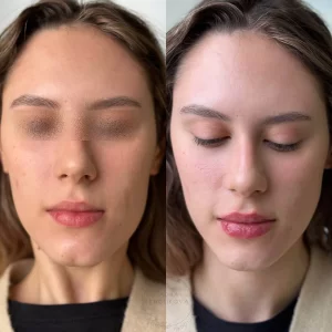 контурная пластика подбородка