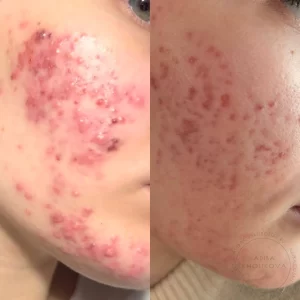 лечение акне