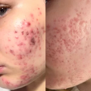 лечение акне