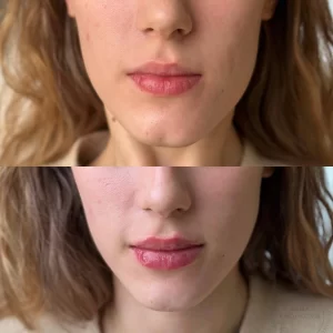 контурная пластика подбородка