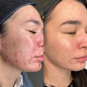 лечение акне