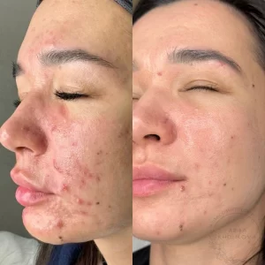 лечение акне