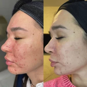 лечение акне