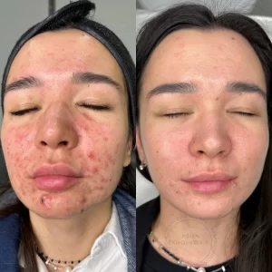 лечение акне