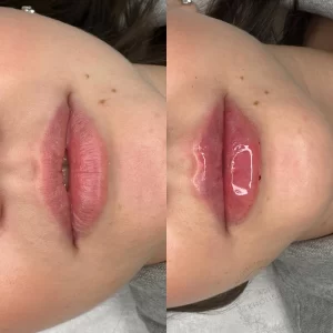 контурная пластика губ