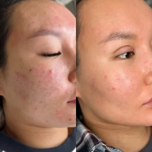 лечение акне