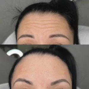 ботокс (ботулинотерапия)