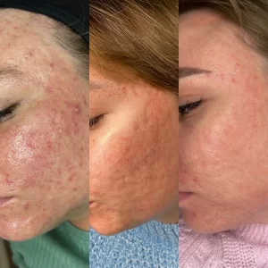 лечение акне