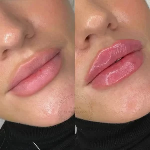 контурная пластика губ