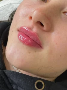 контурная пластика губ