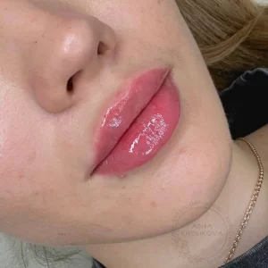 контурная пластика губ