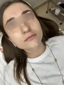 контурная пластика губ