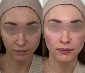 коррекция "мешков под глазами" (заполнение носослёзной борозды)