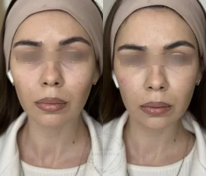 коррекция "мешков под глазами" (заполнение носослёзной борозды)