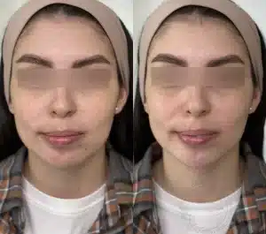 контурная пластика подбородка