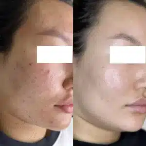 лечение акне