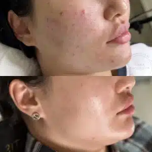 лечение акне