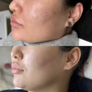 лечение акне