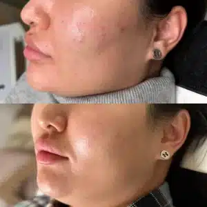 лечение акне