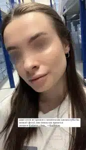 контурная пластика губ