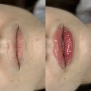 контурная пластика губ