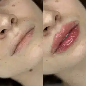 контурная пластика губ