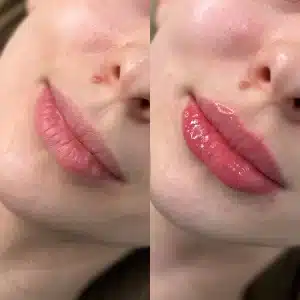 контурная пластика губ