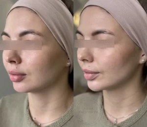 контурная пластика подбородка