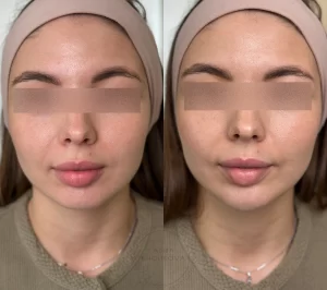 контурная пластика подбородка